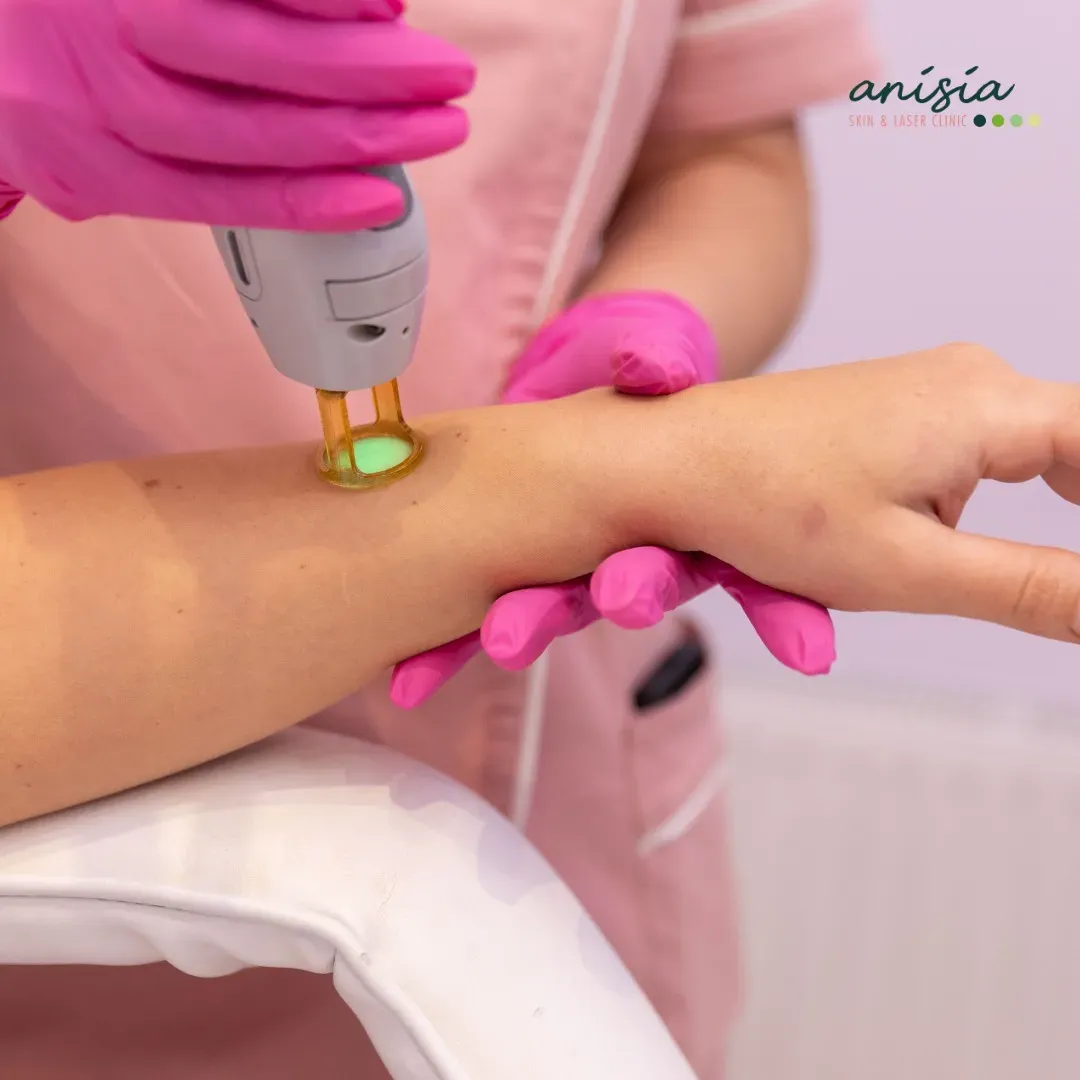 laser-hair-removal.webp
